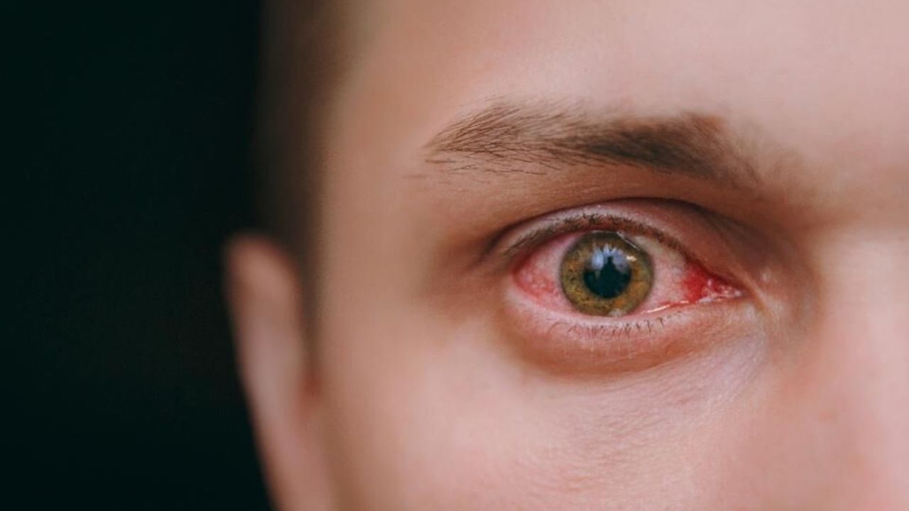 التهاب چشم را جدی بگیرید