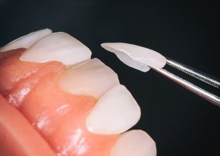 بررسی علل پیدایش درد پس از لمینت دندان