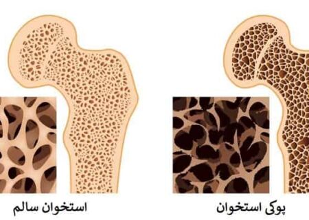 ابتلای ۳۷ درصد زنان بالای ۵۰ سال ایرانی به پوکی استخوان