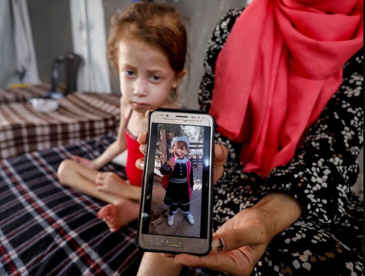 کودکان دچار سوء تغذیه در نوار غزه